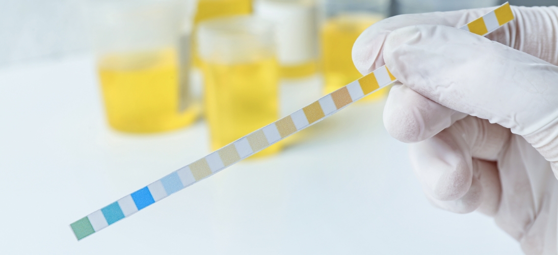 Infection urinaire : un test désormais disponible en pharmacie