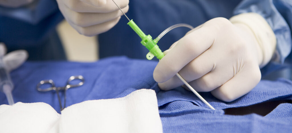 La dénervation rénale, une solution contre l’hypertension - Le ...