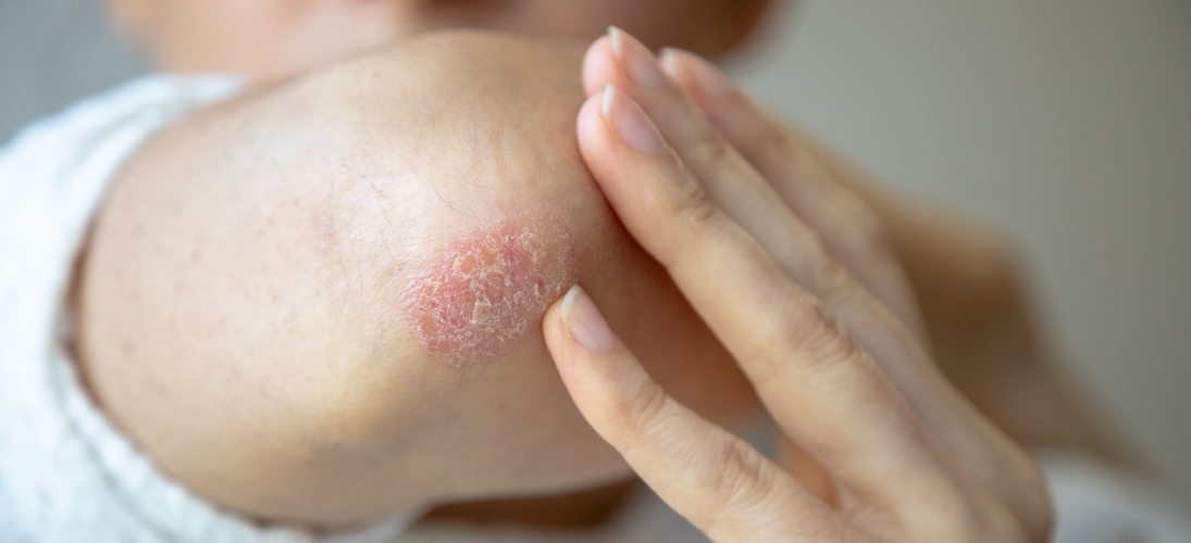 Le psoriasis n’est pas qu’une maladie de la peau